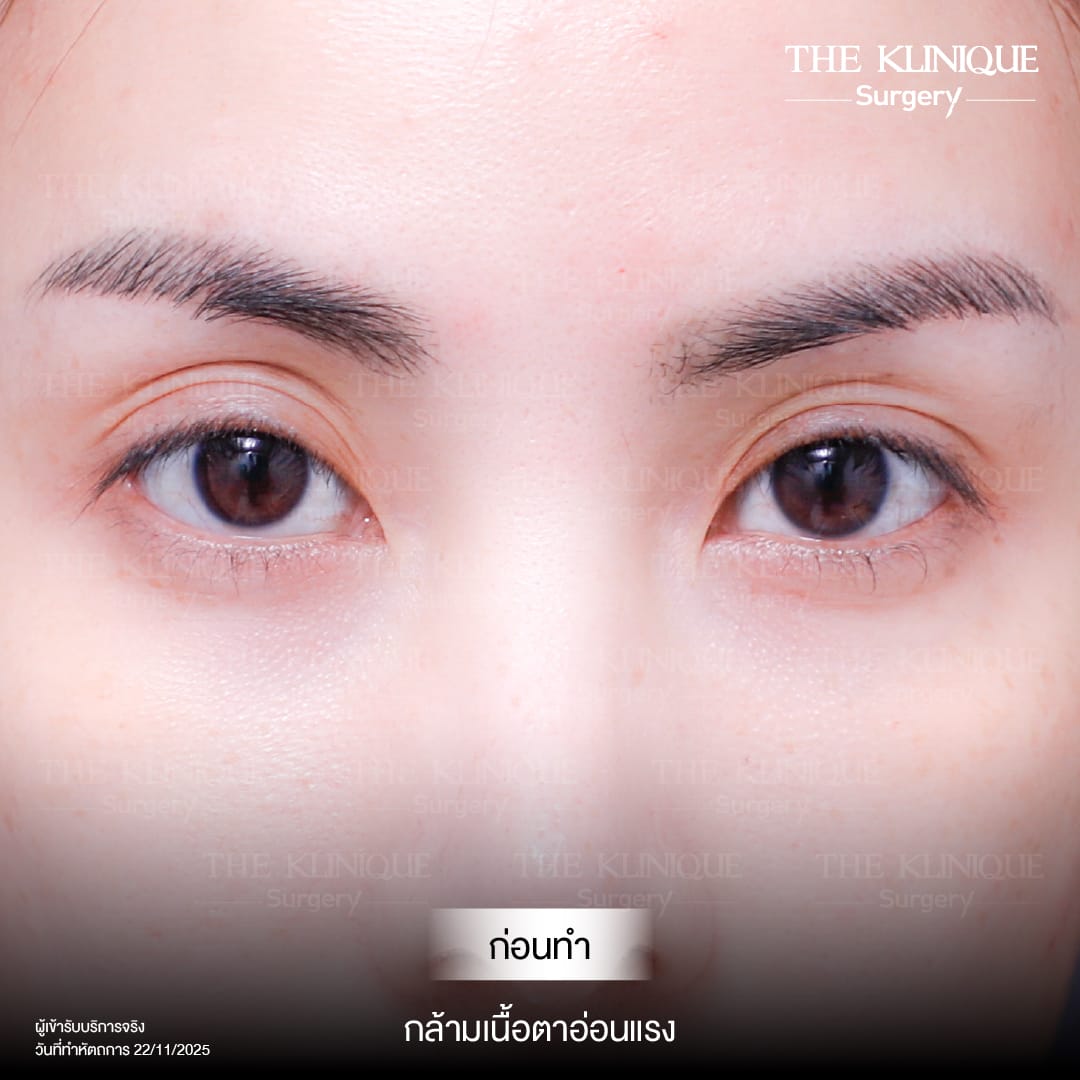 Expert Ophthalmologist Dr. Son analyzing eyelid muscle function for revision surgery