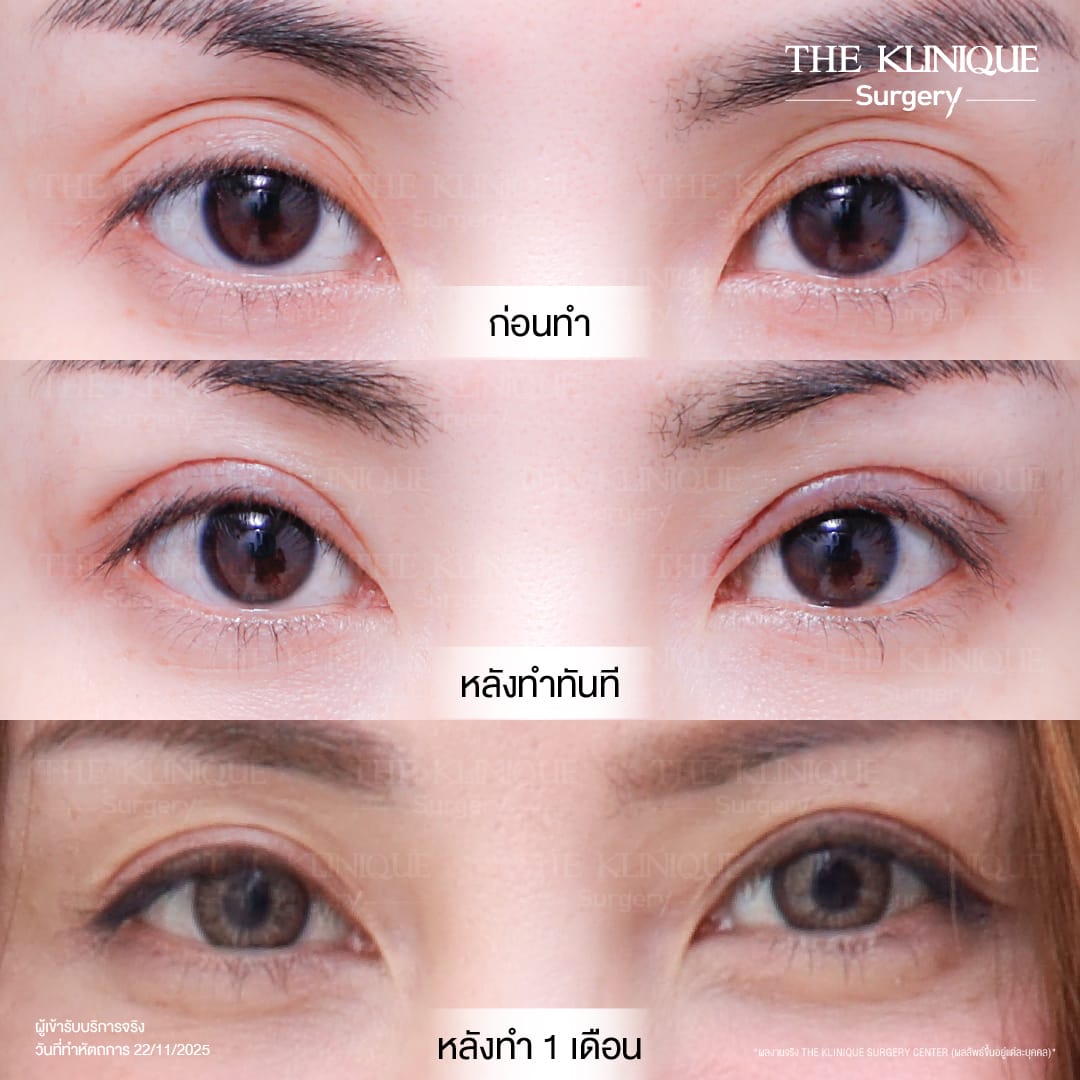 Expert Ophthalmologist Dr. Son analyzing eyelid muscle function for revision surgery
