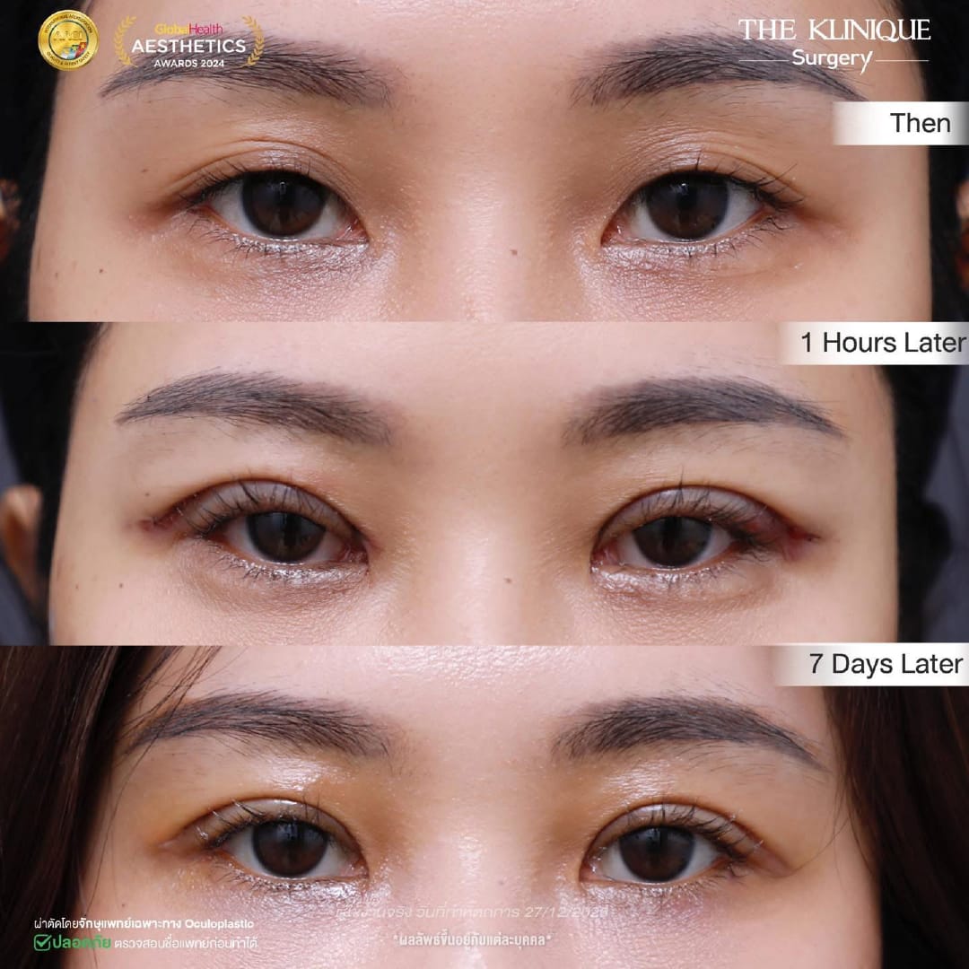 Expert Ophthalmologist Dr. Son analyzing eyelid muscle function for revision surgery