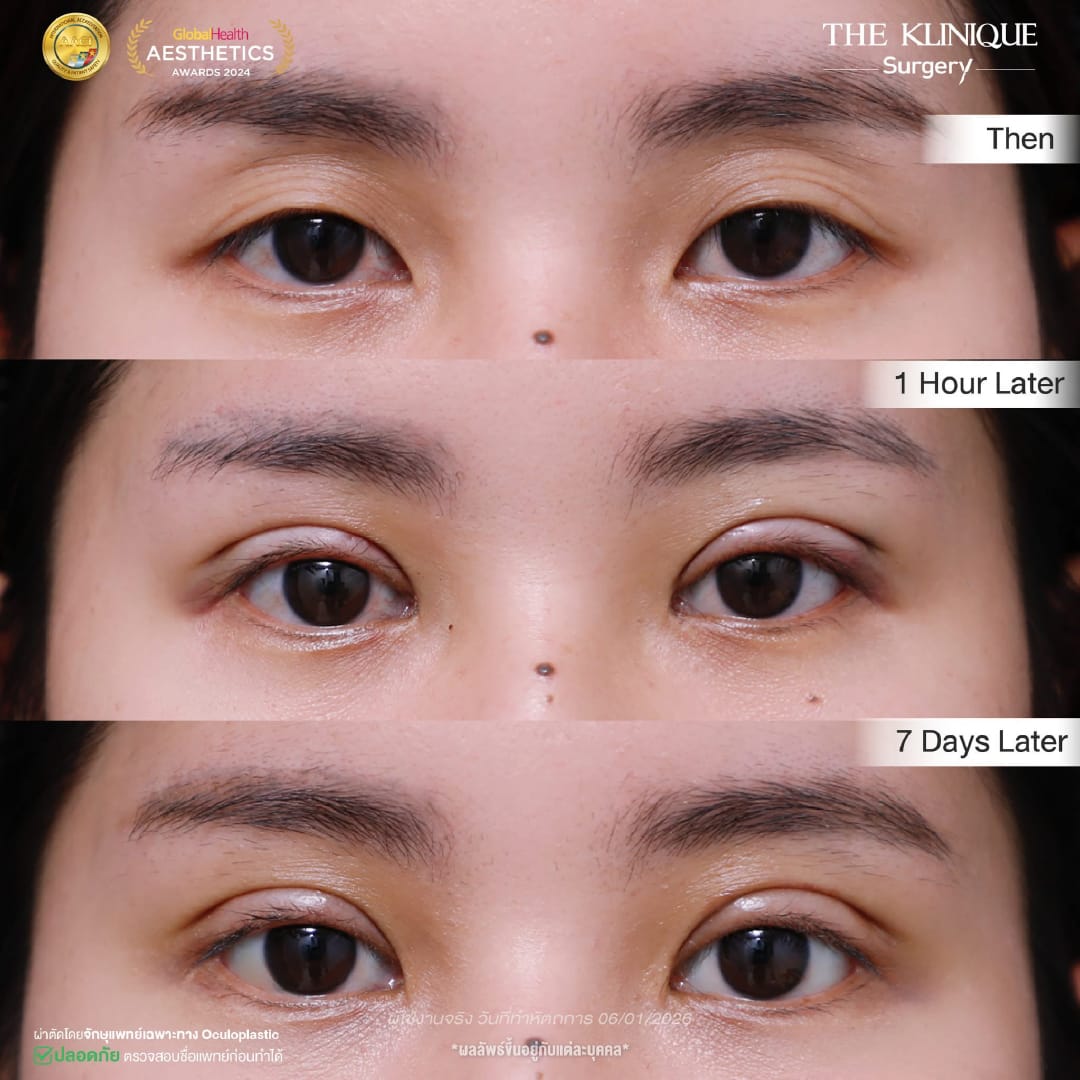 Expert Ophthalmologist Dr. Son analyzing eyelid muscle function for revision surgery