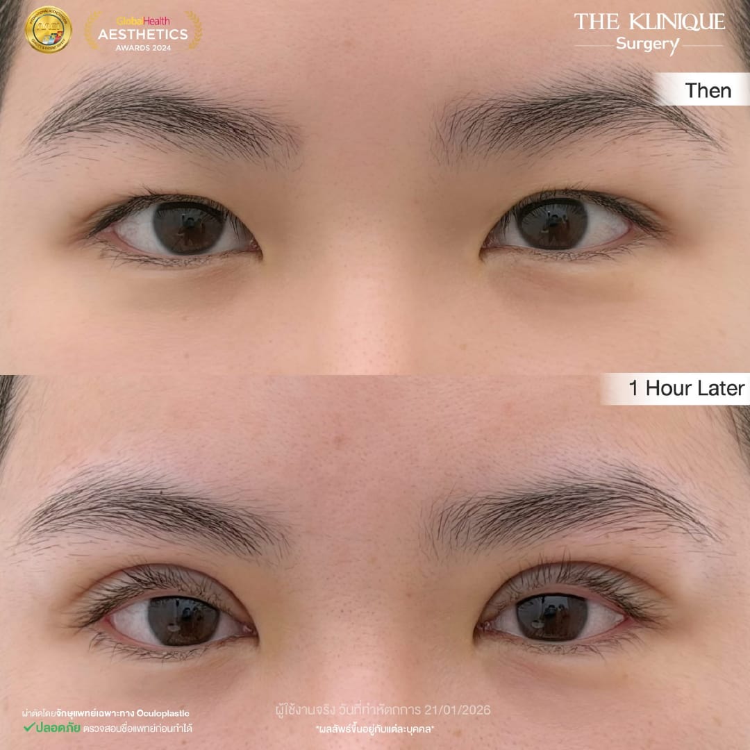 Expert Ophthalmologist Dr. Son analyzing eyelid muscle function for revision surgery