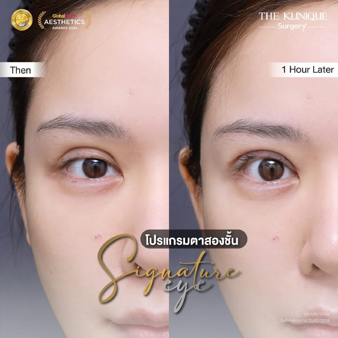 Expert Ophthalmologist Dr. Son analyzing eyelid muscle function for revision surgery