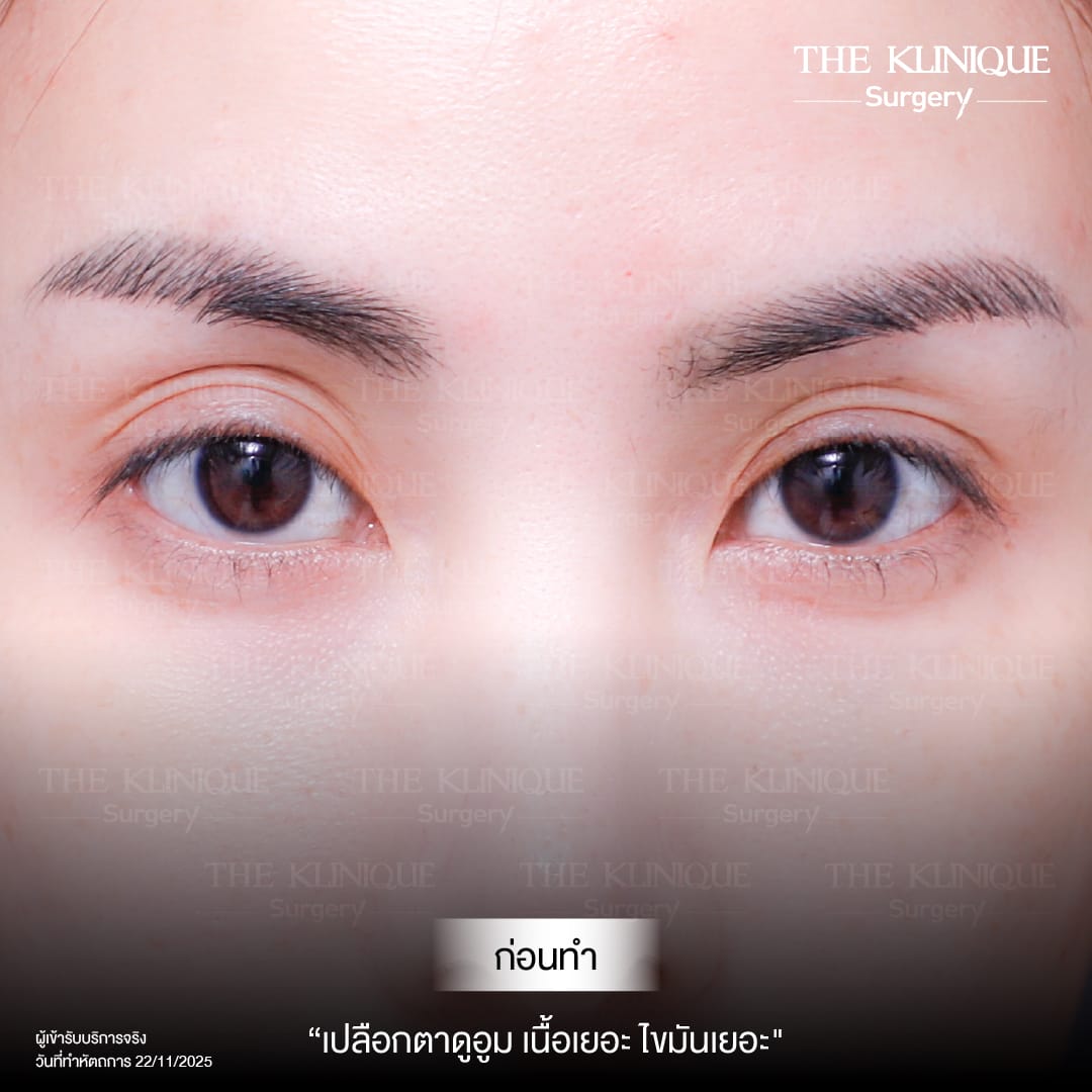 ศัลยกรรมตา, ศัลยกรรมตาสองชั้น, ศัลยกรรมตาสองชั้น ราคา, ศัลยกรรมตาที่ไหนดี, ศัลยกรรมตามีกี่แบบ, ตาสองชั้น, ตาสองชั้นหลบใน, คลินิกทำตา, ตาสองชั้นที่ไหนดี, ตาสองชั้นแบบกรีดสั้น กรีดยาว, กล้ามเนื้อตาอ่อนแรง, แก้ตา, แก้ตาสองชั้น, แก้หนังตาตก, แก้ชั้นตาใหญ่, แก้ตาไม่เท่ากัน, หนังตาตก, แก้หนังตาตก,Ophthalmologis,จักษุศัลยแพทย์,คลินิกทำตาสองชั้น ใจกลางสยามสแคว์ , แก้ตาอ่อนแรง ใจกลางสยาม,ตาง่วง, ตาปรือ, ทำตาสองชั้นที่ไหนดี, แพทย์ Oculoplastic, มัดกล้ามเนื้อตา, รีวิวแก้กล้ามเนื้อตาอ่อนแรง, แก้ไขกล้ามเนื้อตาอ่อนแรง