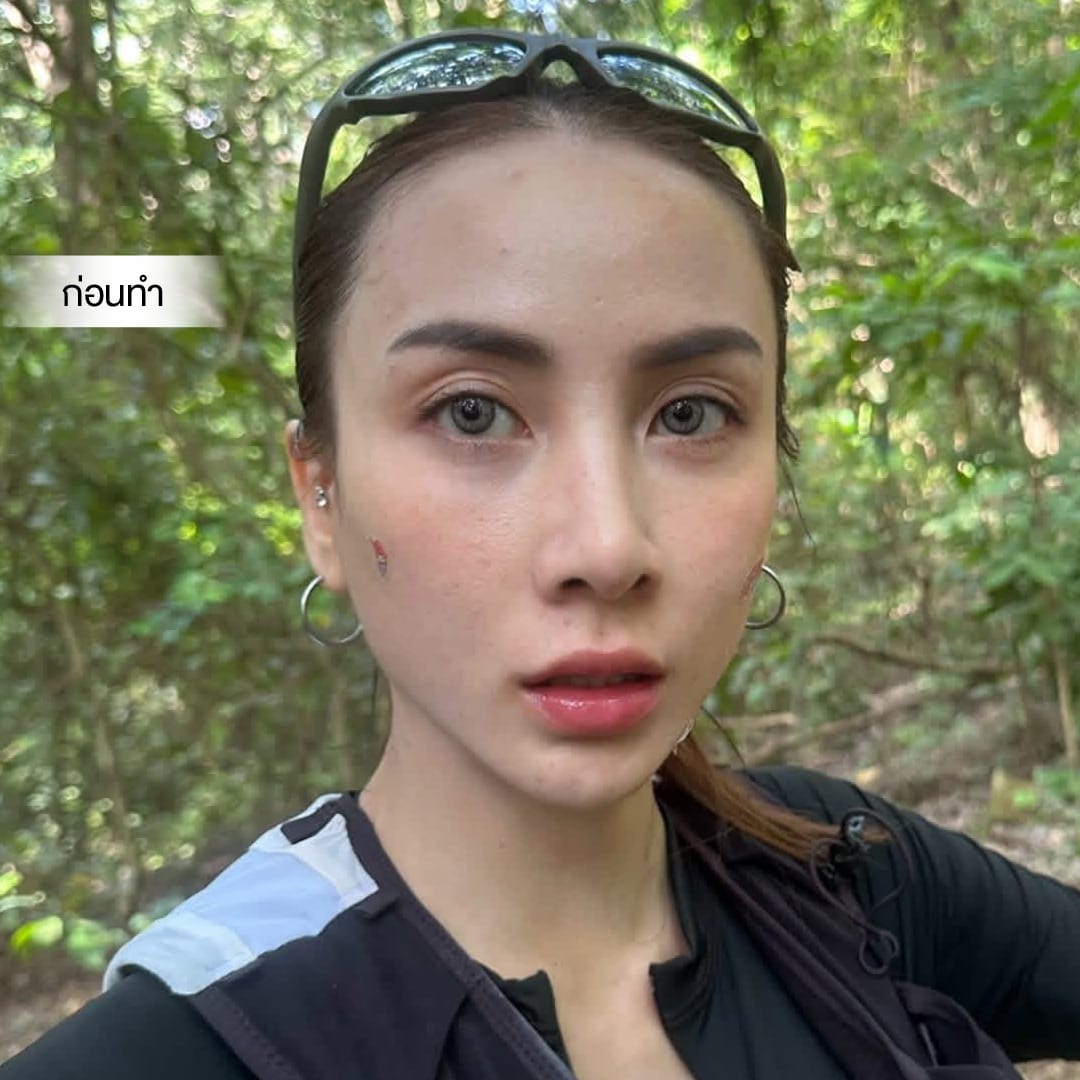 ศัลยกรรมตา, ศัลยกรรมตาสองชั้น, ศัลยกรรมตาสองชั้น ราคา, ศัลยกรรมตาที่ไหนดี, ศัลยกรรมตามีกี่แบบ, ตาสองชั้น, ตาสองชั้นหลบใน, คลินิกทำตา, ตาสองชั้นที่ไหนดี, ตาสองชั้นแบบกรีดสั้น กรีดยาว, กล้ามเนื้อตาอ่อนแรง, แก้ตา, แก้ตาสองชั้น, แก้หนังตาตก, แก้ชั้นตาใหญ่, แก้ตาไม่เท่ากัน, หนังตาตก, แก้หนังตาตก,Ophthalmologis,จักษุศัลยแพทย์,คลินิกทำตาสองชั้น ใจกลางสยามสแคว์ , แก้ตาอ่อนแรง ใจกลางสยาม,ตาง่วง, ตาปรือ, ทำตาสองชั้นที่ไหนดี, แพทย์ Oculoplastic, มัดกล้ามเนื้อตา, รีวิวแก้กล้ามเนื้อตาอ่อนแรง, แก้ไขกล้ามเนื้อตาอ่อนแรง