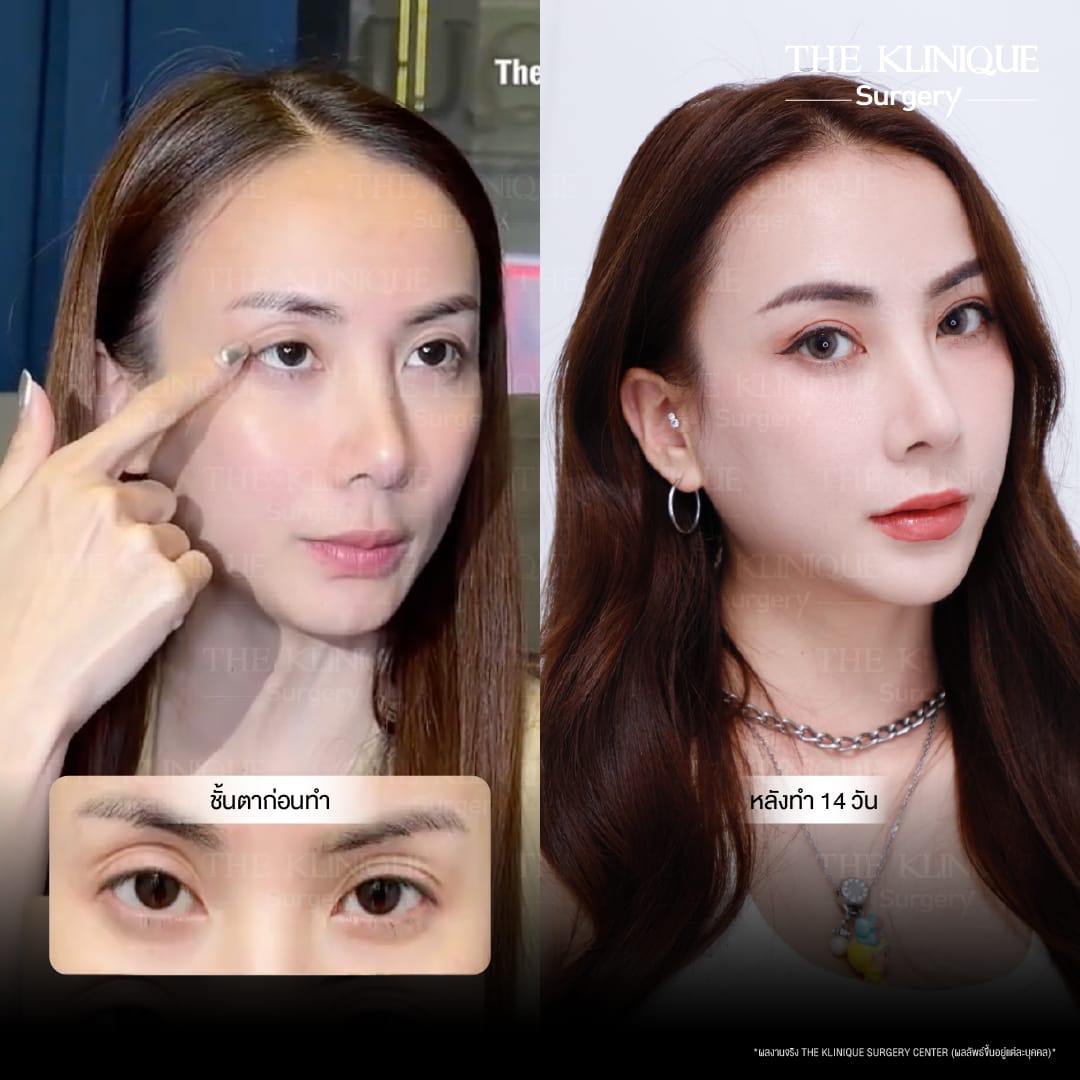 ศัลยกรรมตา, ศัลยกรรมตาสองชั้น, ศัลยกรรมตาสองชั้น ราคา, ศัลยกรรมตาที่ไหนดี, ศัลยกรรมตามีกี่แบบ, ตาสองชั้น, ตาสองชั้นหลบใน, คลินิกทำตา, ตาสองชั้นที่ไหนดี, ตาสองชั้นแบบกรีดสั้น กรีดยาว, กล้ามเนื้อตาอ่อนแรง, แก้ตา, แก้ตาสองชั้น, แก้หนังตาตก, แก้ชั้นตาใหญ่, แก้ตาไม่เท่ากัน, หนังตาตก, แก้หนังตาตก,Ophthalmologis,จักษุศัลยแพทย์,คลินิกทำตาสองชั้น ใจกลางสยามสแคว์ , แก้ตาอ่อนแรง ใจกลางสยาม,ตาง่วง, ตาปรือ, ทำตาสองชั้นที่ไหนดี, แพทย์ Oculoplastic, มัดกล้ามเนื้อตา, รีวิวแก้กล้ามเนื้อตาอ่อนแรง, แก้ไขกล้ามเนื้อตาอ่อนแรง