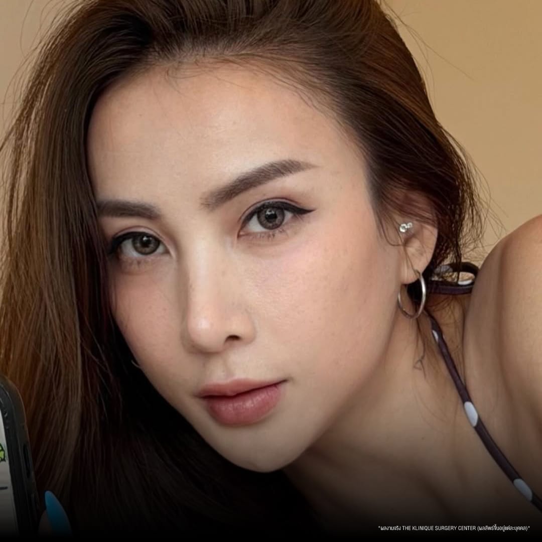 ศัลยกรรมตา, ศัลยกรรมตาสองชั้น, ศัลยกรรมตาสองชั้น ราคา, ศัลยกรรมตาที่ไหนดี, ศัลยกรรมตามีกี่แบบ, ตาสองชั้น, ตาสองชั้นหลบใน, คลินิกทำตา, ตาสองชั้นที่ไหนดี, ตาสองชั้นแบบกรีดสั้น กรีดยาว, กล้ามเนื้อตาอ่อนแรง, แก้ตา, แก้ตาสองชั้น, แก้หนังตาตก, แก้ชั้นตาใหญ่, แก้ตาไม่เท่ากัน, หนังตาตก, แก้หนังตาตก,Ophthalmologis,จักษุศัลยแพทย์,คลินิกทำตาสองชั้น ใจกลางสยามสแคว์ , แก้ตาอ่อนแรง ใจกลางสยาม,ตาง่วง, ตาปรือ, ทำตาสองชั้นที่ไหนดี, แพทย์ Oculoplastic, มัดกล้ามเนื้อตา, รีวิวแก้กล้ามเนื้อตาอ่อนแรง, แก้ไขกล้ามเนื้อตาอ่อนแรง