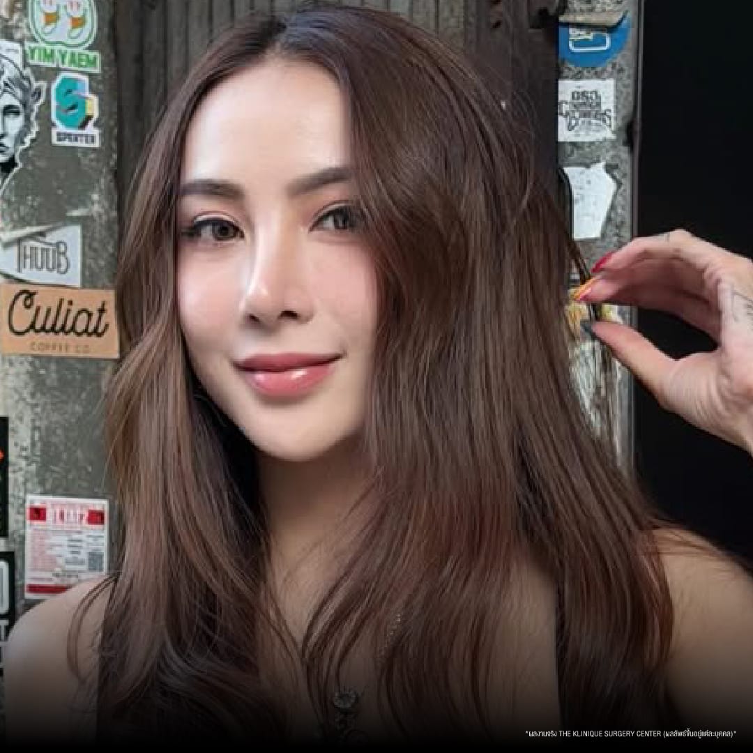 ศัลยกรรมตา, ศัลยกรรมตาสองชั้น, ศัลยกรรมตาสองชั้น ราคา, ศัลยกรรมตาที่ไหนดี, ศัลยกรรมตามีกี่แบบ, ตาสองชั้น, ตาสองชั้นหลบใน, คลินิกทำตา, ตาสองชั้นที่ไหนดี, ตาสองชั้นแบบกรีดสั้น กรีดยาว, กล้ามเนื้อตาอ่อนแรง, แก้ตา, แก้ตาสองชั้น, แก้หนังตาตก, แก้ชั้นตาใหญ่, แก้ตาไม่เท่ากัน, หนังตาตก, แก้หนังตาตก,Ophthalmologis,จักษุศัลยแพทย์,คลินิกทำตาสองชั้น ใจกลางสยามสแคว์ , แก้ตาอ่อนแรง ใจกลางสยาม,ตาง่วง, ตาปรือ, ทำตาสองชั้นที่ไหนดี, แพทย์ Oculoplastic, มัดกล้ามเนื้อตา, รีวิวแก้กล้ามเนื้อตาอ่อนแรง, แก้ไขกล้ามเนื้อตาอ่อนแรง