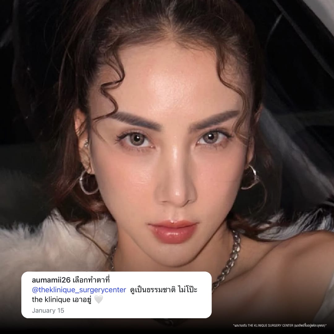 ศัลยกรรมตา, ศัลยกรรมตาสองชั้น, ศัลยกรรมตาสองชั้น ราคา, ศัลยกรรมตาที่ไหนดี, ศัลยกรรมตามีกี่แบบ, ตาสองชั้น, ตาสองชั้นหลบใน, คลินิกทำตา, ตาสองชั้นที่ไหนดี, ตาสองชั้นแบบกรีดสั้น กรีดยาว, กล้ามเนื้อตาอ่อนแรง, แก้ตา, แก้ตาสองชั้น, แก้หนังตาตก, แก้ชั้นตาใหญ่, แก้ตาไม่เท่ากัน, หนังตาตก, แก้หนังตาตก,Ophthalmologis,จักษุศัลยแพทย์,คลินิกทำตาสองชั้น ใจกลางสยามสแคว์ , แก้ตาอ่อนแรง ใจกลางสยาม,ตาง่วง, ตาปรือ, ทำตาสองชั้นที่ไหนดี, แพทย์ Oculoplastic, มัดกล้ามเนื้อตา, รีวิวแก้กล้ามเนื้อตาอ่อนแรง, แก้ไขกล้ามเนื้อตาอ่อนแรง