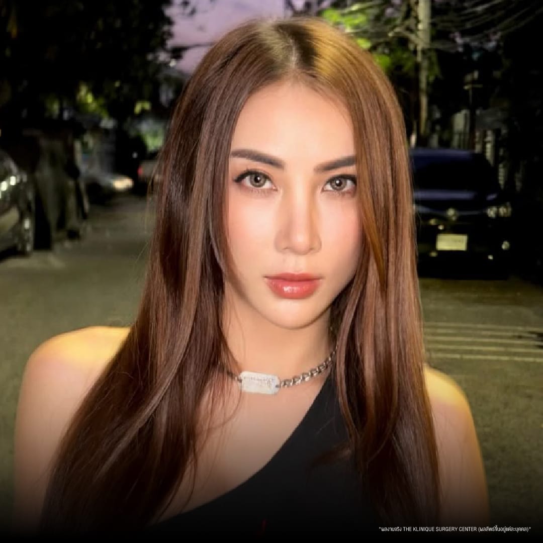 ศัลยกรรมตา, ศัลยกรรมตาสองชั้น, ศัลยกรรมตาสองชั้น ราคา, ศัลยกรรมตาที่ไหนดี, ศัลยกรรมตามีกี่แบบ, ตาสองชั้น, ตาสองชั้นหลบใน, คลินิกทำตา, ตาสองชั้นที่ไหนดี, ตาสองชั้นแบบกรีดสั้น กรีดยาว, กล้ามเนื้อตาอ่อนแรง, แก้ตา, แก้ตาสองชั้น, แก้หนังตาตก, แก้ชั้นตาใหญ่, แก้ตาไม่เท่ากัน, หนังตาตก, แก้หนังตาตก,Ophthalmologis,จักษุศัลยแพทย์,คลินิกทำตาสองชั้น ใจกลางสยามสแคว์ , แก้ตาอ่อนแรง ใจกลางสยาม,ตาง่วง, ตาปรือ, ทำตาสองชั้นที่ไหนดี, แพทย์ Oculoplastic, มัดกล้ามเนื้อตา, รีวิวแก้กล้ามเนื้อตาอ่อนแรง, แก้ไขกล้ามเนื้อตาอ่อนแรง