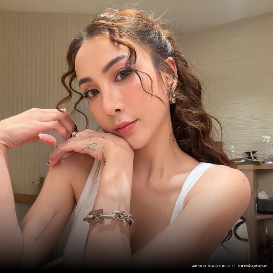 ศัลยกรรมตา, ศัลยกรรมตาสองชั้น, ศัลยกรรมตาสองชั้น ราคา, ศัลยกรรมตาที่ไหนดี, ศัลยกรรมตามีกี่แบบ, ตาสองชั้น, ตาสองชั้นหลบใน, คลินิกทำตา, ตาสองชั้นที่ไหนดี, ตาสองชั้นแบบกรีดสั้น กรีดยาว, กล้ามเนื้อตาอ่อนแรง, แก้ตา, แก้ตาสองชั้น, แก้หนังตาตก, แก้ชั้นตาใหญ่, แก้ตาไม่เท่ากัน, หนังตาตก, แก้หนังตาตก,Ophthalmologis,จักษุศัลยแพทย์,คลินิกทำตาสองชั้น ใจกลางสยามสแคว์ , แก้ตาอ่อนแรง ใจกลางสยาม,ตาง่วง, ตาปรือ, ทำตาสองชั้นที่ไหนดี, แพทย์ Oculoplastic, มัดกล้ามเนื้อตา, รีวิวแก้กล้ามเนื้อตาอ่อนแรง, แก้ไขกล้ามเนื้อตาอ่อนแรง