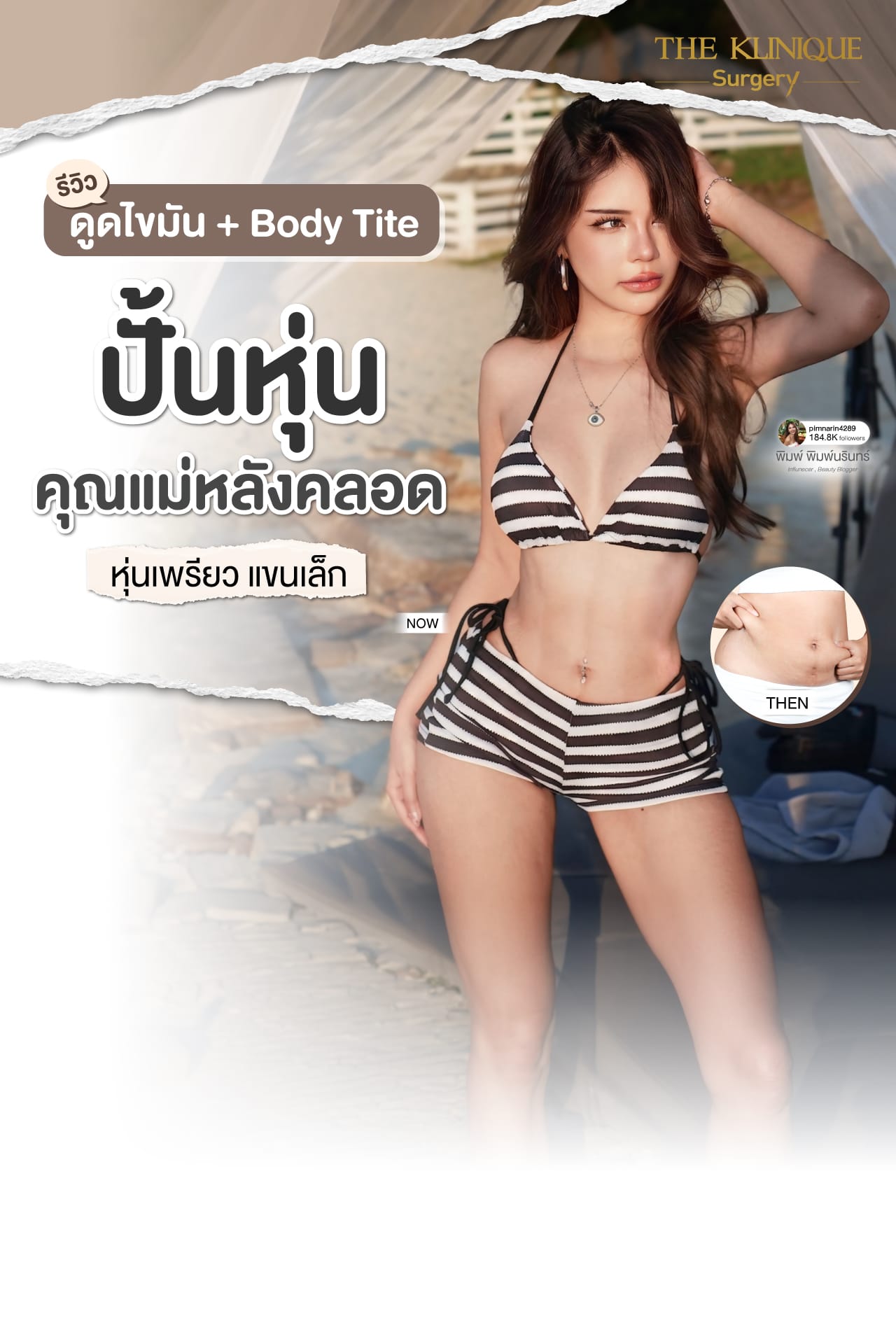 รีวิวดูดไขมันหน้าท้องและเอวด้วยเครื่อง BodyTite โดยหมอจอง