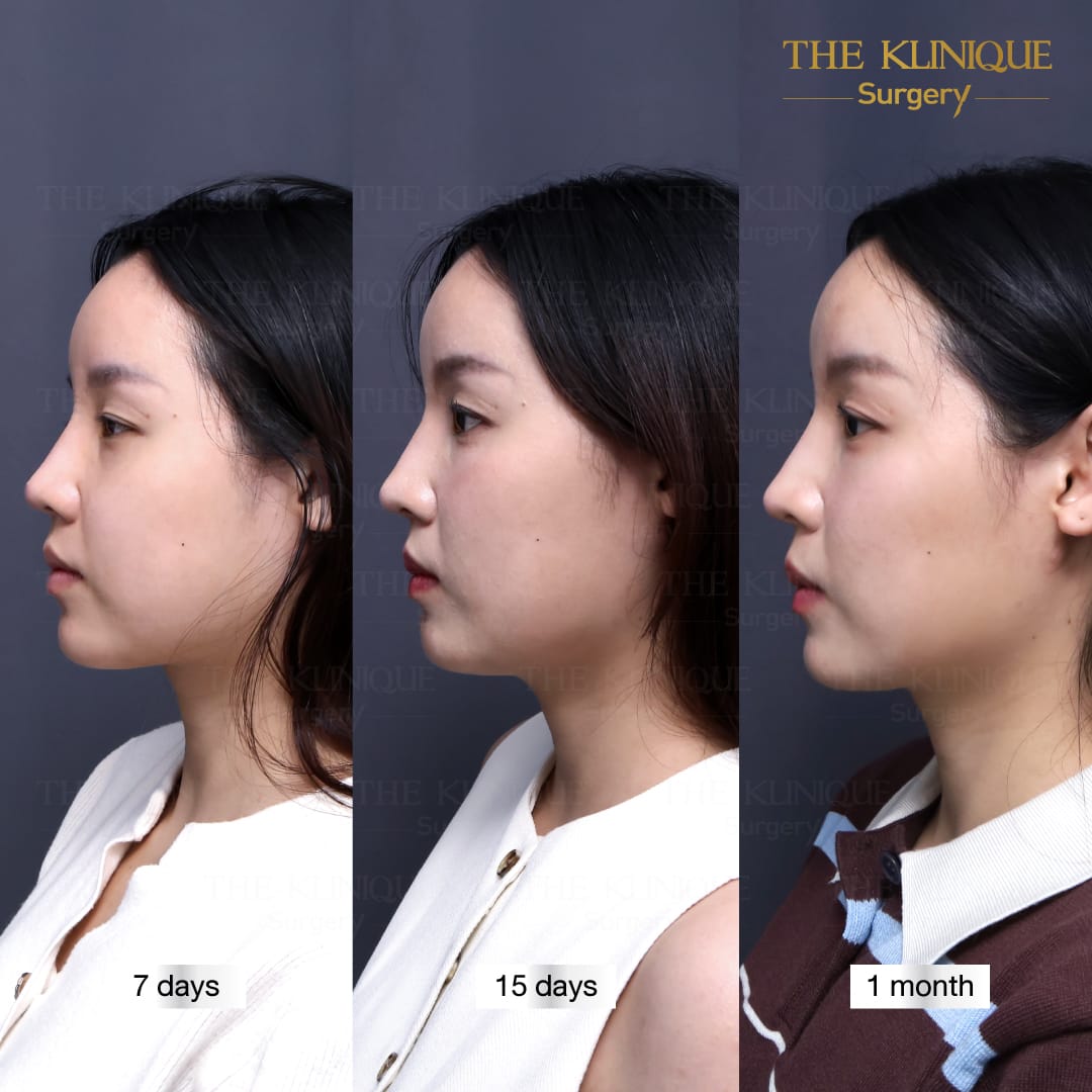รีวิวเสริมจมูก Semi Open ทรงสโลปปลายพุ่งสไตล์ Gen Z โดยคุณหมอโซอา