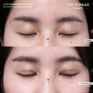 Double Eyelid Surgery