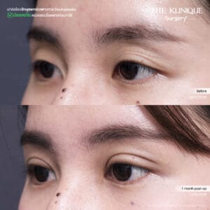 Double Eyelid Surgery