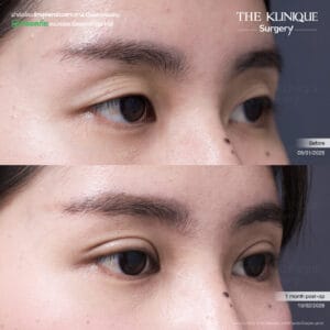 Double Eyelid Surgery