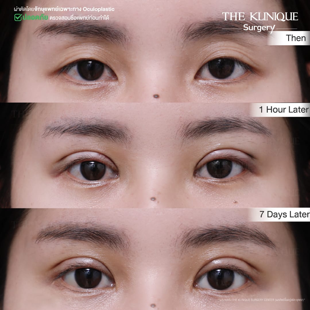 Double Eyelid Surgery