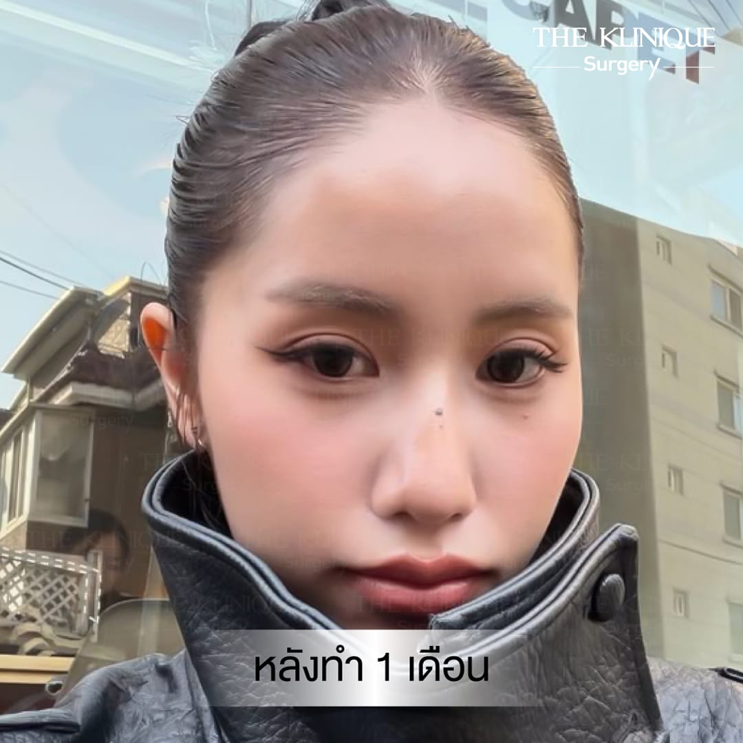Double Eyelid Surgery