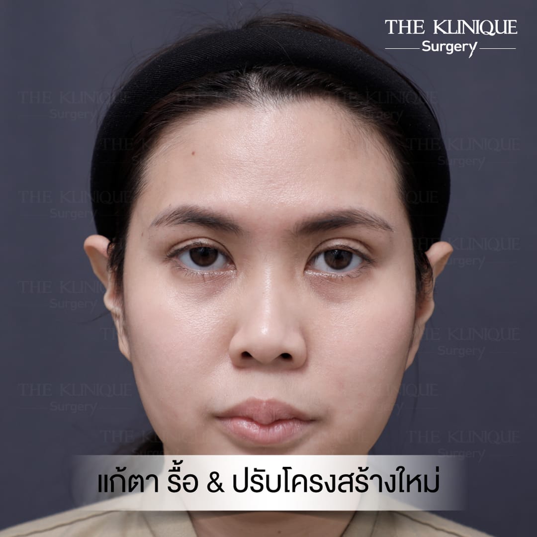 Double Eyelid Surgery