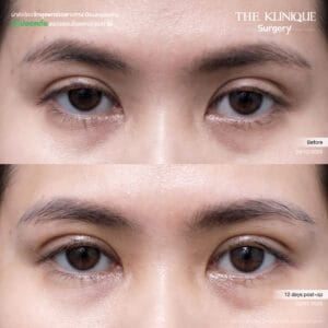 Double Eyelid Surgery