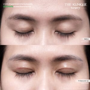 Double Eyelid Surgery