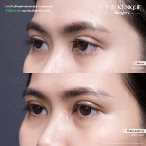 Double Eyelid Surgery