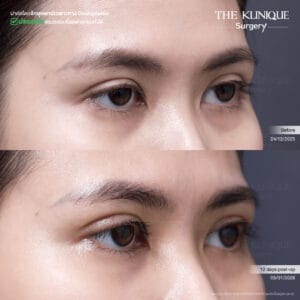 Double Eyelid Surgery