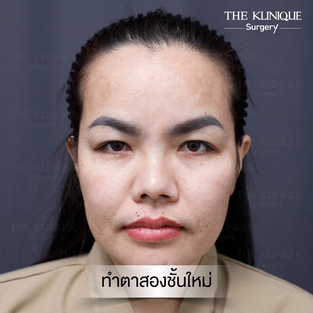 Double Eyelid Surgery