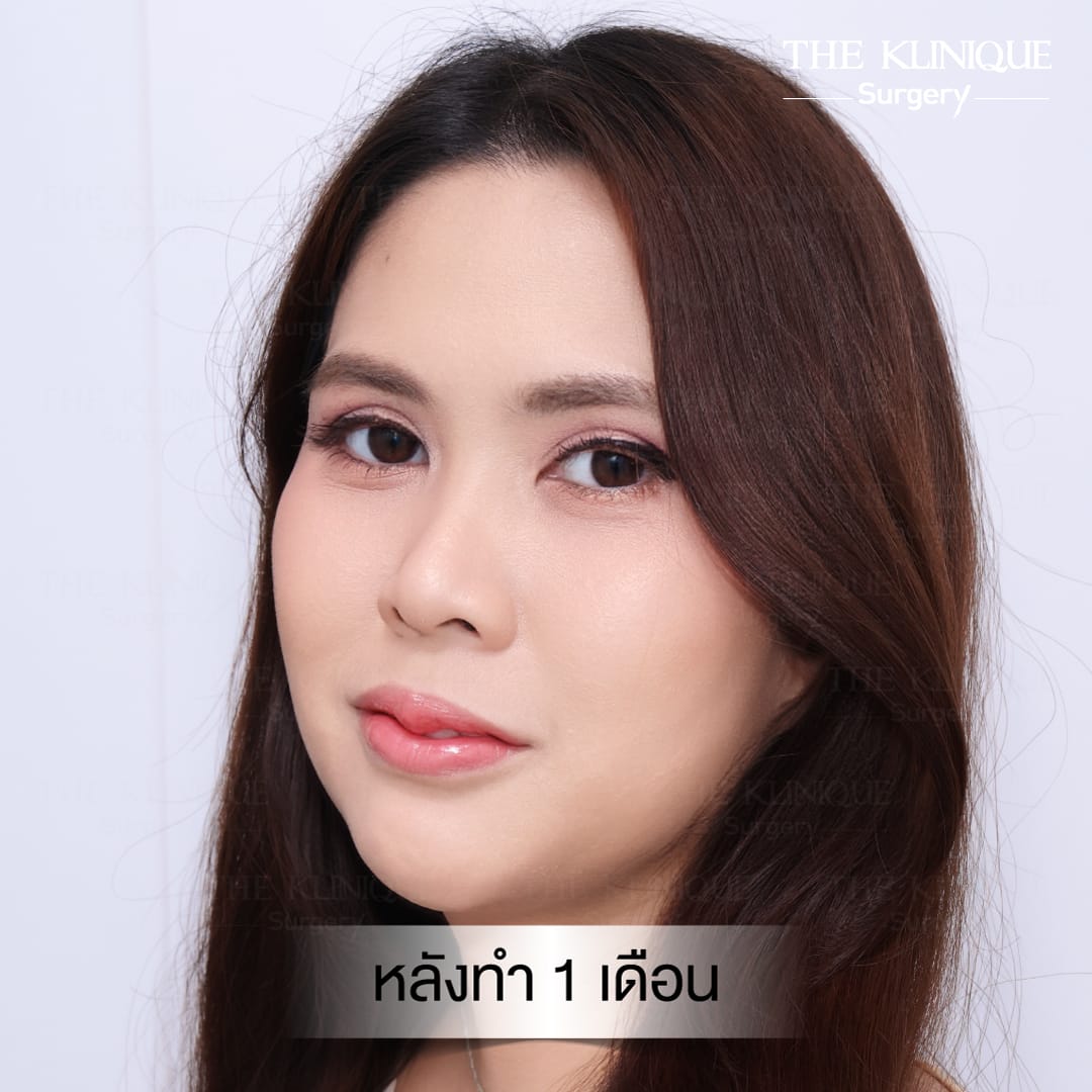 Double Eyelid Surgery