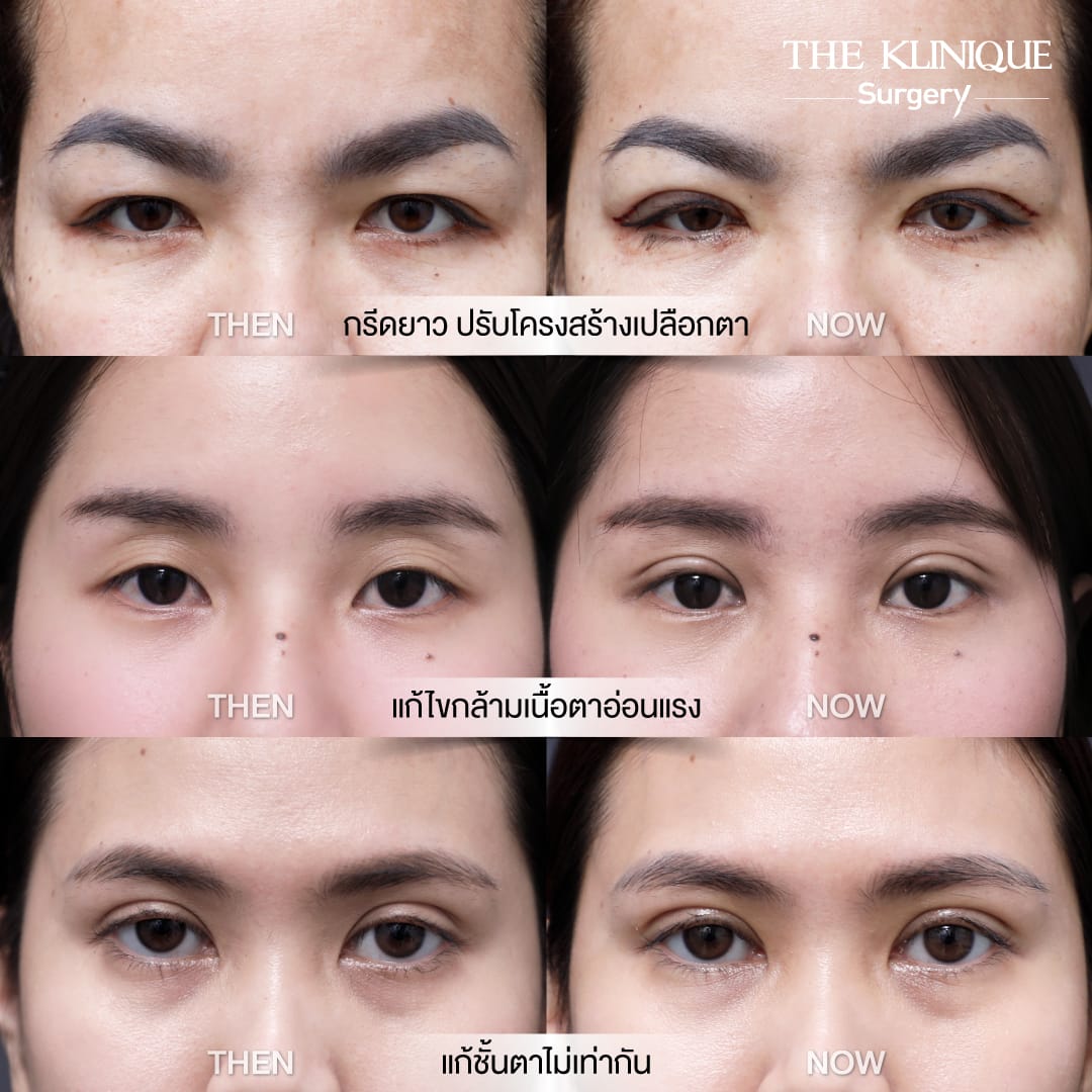 Double Eyelid Surgery