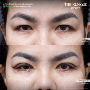 Double Eyelid Surgery