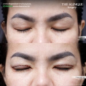 Double Eyelid Surgery