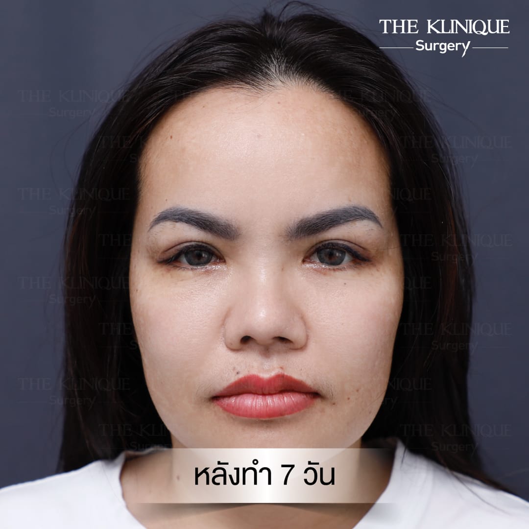 Double Eyelid Surgery