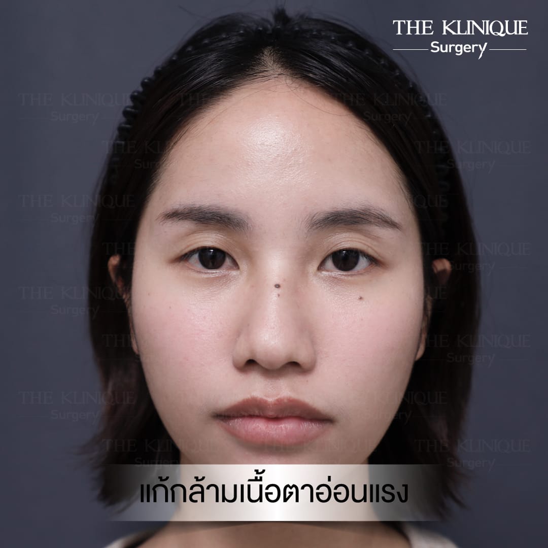 Double Eyelid Surgery