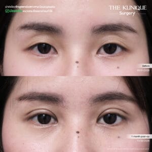 Double Eyelid Surgery
