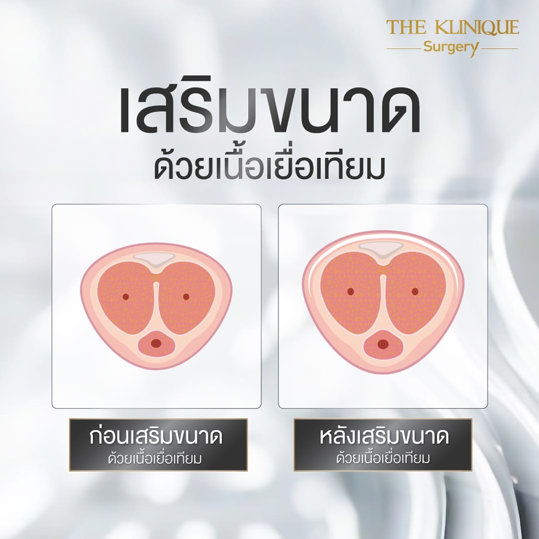 เพิ่มขนาดน้องชาย-เนื้อเยื่อเทียม-Drหน่อง