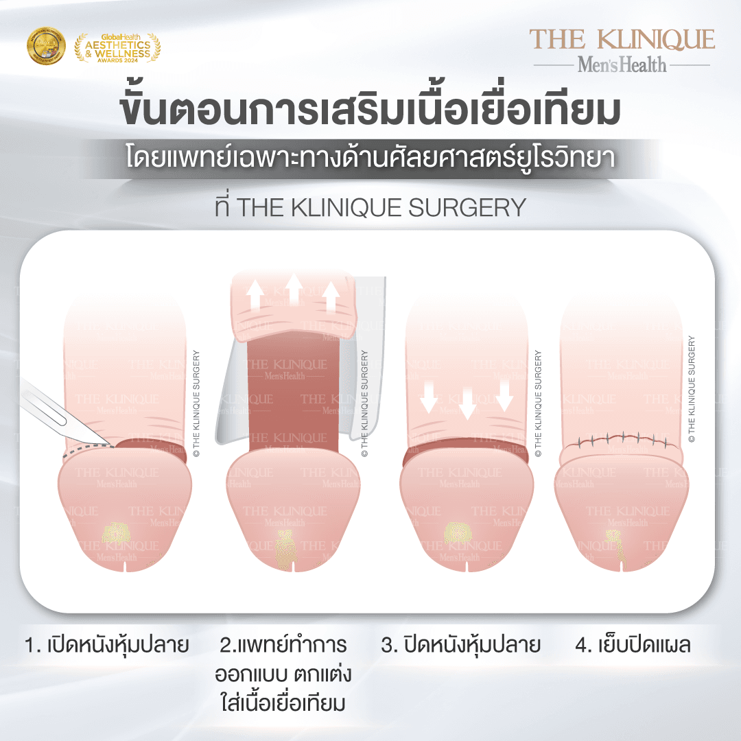 เพิ่มขนาดน้องชาย-เนื้อเยื่อเทียม-Drหน่อง