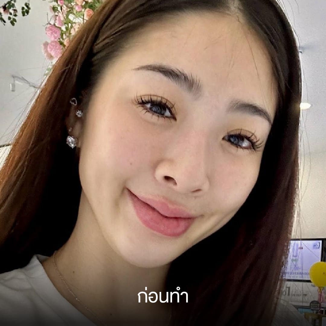 ศัลยกรรมจมูก, ศัลยกรรมจมูก รีวิว, เสริมจมูก, รีวิวเสริมจมูก, ทำจมูก, ทำจมูก รีวิว, ทำจมูก แบบ Open, ซิลิโคนจมูก, จมูก Open, เสริมจมูกโอเพ่น, เสริมจมูกOpen ที่ไหนดี, เสริมจมูกโอเพ่น ที่ไหนดี, เสริมจมูกโอเพ่น Open คือ, รีวิวเสริมจมูกโอเพ่น Open, ทรงจมูก, ทรงจมูกสวย, ทรงจมูกธรรมชาติ, ทรงจมูกสโลปปลายพุ่ง, ศัลยกรรมจมูกทีไ่หนดี, ศัลยกรรมจมูกมีกี่แบบ, เสริมจมูกที่ไหนดี, เสริมจมูกโอเพ่น, เสริมจมูกOpen, ทำจมูกรีวิว, ซิลิโคนจมูก,แก้จมูก, แก้จมูกที่ไหนดี, ทรงจมูกผู้ชาย, เสริมจมูกผู้ชาย, ศัลยฯจมูก, ถอดซิลิโคนจมูก, จมูก Semi Open