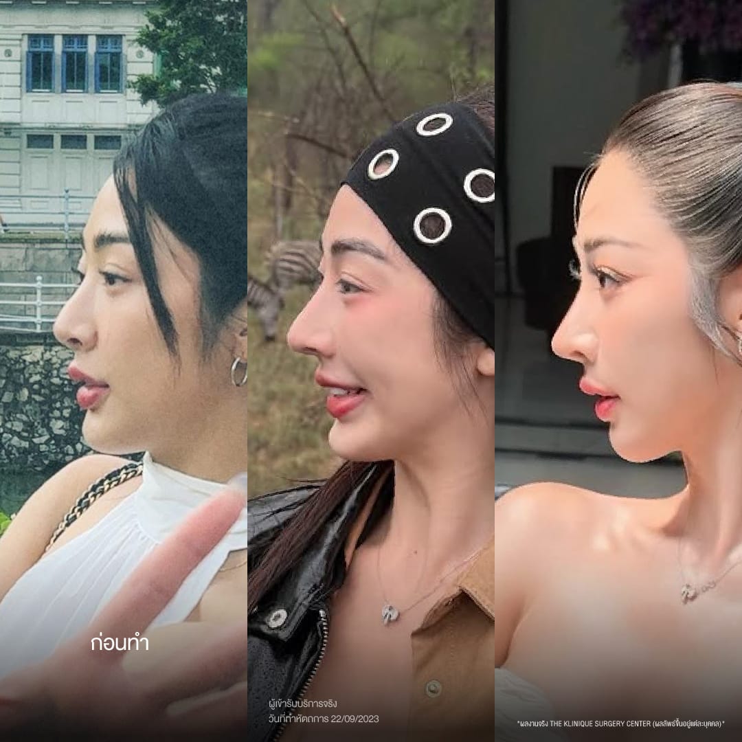 ศัลยกรรมจมูก, ศัลยกรรมจมูก รีวิว, เสริมจมูก, รีวิวเสริมจมูก, ทำจมูก, ทำจมูก รีวิว, ทำจมูก แบบ Open, ซิลิโคนจมูก, จมูก Open, เสริมจมูกโอเพ่น, เสริมจมูกOpen ที่ไหนดี, เสริมจมูกโอเพ่น ที่ไหนดี, เสริมจมูกโอเพ่น Open คือ, รีวิวเสริมจมูกโอเพ่น Open, ทรงจมูก, ทรงจมูกสวย, ทรงจมูกธรรมชาติ, ทรงจมูกสโลปปลายพุ่ง, ศัลยกรรมจมูกทีไ่หนดี, ศัลยกรรมจมูกมีกี่แบบ, เสริมจมูกที่ไหนดี, เสริมจมูกโอเพ่น, เสริมจมูกOpen, ทำจมูกรีวิว, ซิลิโคนจมูก,แก้จมูก, แก้จมูกที่ไหนดี, ทรงจมูกผู้ชาย, เสริมจมูกผู้ชาย, ศัลยฯจมูก, ถอดซิลิโคนจมูก, จมูก Semi Open