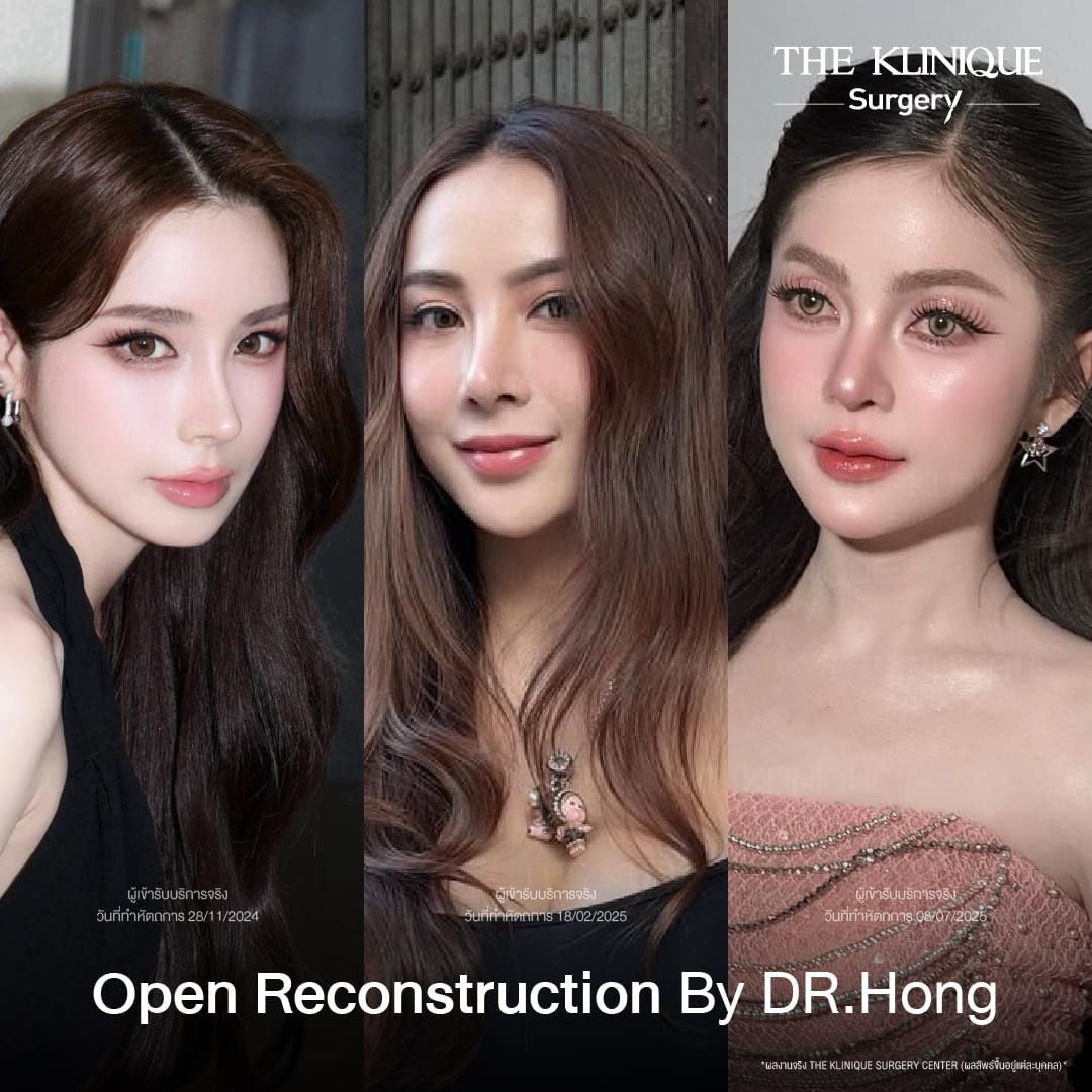 ศัลยกรรมจมูก, ศัลยกรรมจมูก รีวิว, เสริมจมูก, รีวิวเสริมจมูก, ทำจมูก, ทำจมูก รีวิว, ทำจมูก แบบ Open, ซิลิโคนจมูก, จมูก Open, เสริมจมูกโอเพ่น, เสริมจมูกOpen ที่ไหนดี, เสริมจมูกโอเพ่น ที่ไหนดี, เสริมจมูกโอเพ่น Open คือ, รีวิวเสริมจมูกโอเพ่น Open, ทรงจมูก, ทรงจมูกสวย, ทรงจมูกธรรมชาติ, ทรงจมูกสโลปปลายพุ่ง, ศัลยกรรมจมูกทีไ่หนดี, ศัลยกรรมจมูกมีกี่แบบ, เสริมจมูกที่ไหนดี, เสริมจมูกโอเพ่น, เสริมจมูกOpen, ทำจมูกรีวิว, ซิลิโคนจมูก,แก้จมูก, แก้จมูกที่ไหนดี, ทรงจมูกผู้ชาย, เสริมจมูกผู้ชาย, ศัลยฯจมูก, ถอดซิลิโคนจมูก, จมูก Semi Open
