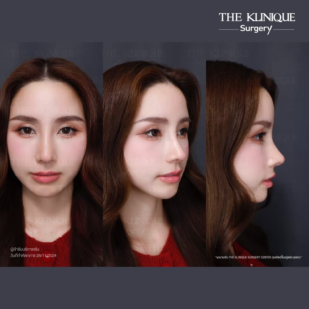 ศัลยกรรมจมูก, ศัลยกรรมจมูก รีวิว, เสริมจมูก, รีวิวเสริมจมูก, ทำจมูก, ทำจมูก รีวิว, ทำจมูก แบบ Open, ซิลิโคนจมูก, จมูก Open, เสริมจมูกโอเพ่น, เสริมจมูกOpen ที่ไหนดี, เสริมจมูกโอเพ่น ที่ไหนดี, เสริมจมูกโอเพ่น Open คือ, รีวิวเสริมจมูกโอเพ่น Open, ทรงจมูก, ทรงจมูกสวย, ทรงจมูกธรรมชาติ, ทรงจมูกสโลปปลายพุ่ง, ศัลยกรรมจมูกทีไ่หนดี, ศัลยกรรมจมูกมีกี่แบบ, เสริมจมูกที่ไหนดี, เสริมจมูกโอเพ่น, เสริมจมูกOpen, ทำจมูกรีวิว, ซิลิโคนจมูก,แก้จมูก, แก้จมูกที่ไหนดี, ทรงจมูกผู้ชาย, เสริมจมูกผู้ชาย, ศัลยฯจมูก, ถอดซิลิโคนจมูก, จมูก Semi Open