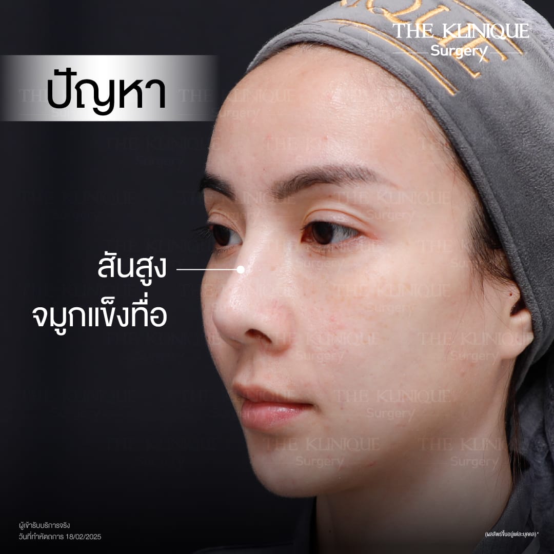 ศัลยกรรมจมูก, ศัลยกรรมจมูก รีวิว, เสริมจมูก, รีวิวเสริมจมูก, ทำจมูก, ทำจมูก รีวิว, ทำจมูก แบบ Open, ซิลิโคนจมูก, จมูก Open, เสริมจมูกโอเพ่น, เสริมจมูกOpen ที่ไหนดี, เสริมจมูกโอเพ่น ที่ไหนดี, เสริมจมูกโอเพ่น Open คือ, รีวิวเสริมจมูกโอเพ่น Open, ทรงจมูก, ทรงจมูกสวย, ทรงจมูกธรรมชาติ, ทรงจมูกสโลปปลายพุ่ง, ศัลยกรรมจมูกทีไ่หนดี, ศัลยกรรมจมูกมีกี่แบบ, เสริมจมูกที่ไหนดี, เสริมจมูกโอเพ่น, เสริมจมูกOpen, ทำจมูกรีวิว, ซิลิโคนจมูก,แก้จมูก, แก้จมูกที่ไหนดี, ทรงจมูกผู้ชาย, เสริมจมูกผู้ชาย, ศัลยฯจมูก, ถอดซิลิโคนจมูก, จมูก Semi Open