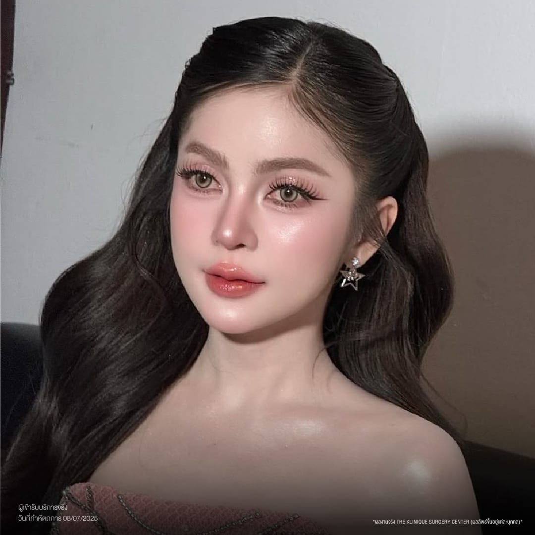 ศัลยกรรมจมูก, ศัลยกรรมจมูก รีวิว, เสริมจมูก, รีวิวเสริมจมูก, ทำจมูก, ทำจมูก รีวิว, ทำจมูก แบบ Open, ซิลิโคนจมูก, จมูก Open, เสริมจมูกโอเพ่น, เสริมจมูกOpen ที่ไหนดี, เสริมจมูกโอเพ่น ที่ไหนดี, เสริมจมูกโอเพ่น Open คือ, รีวิวเสริมจมูกโอเพ่น Open, ทรงจมูก, ทรงจมูกสวย, ทรงจมูกธรรมชาติ, ทรงจมูกสโลปปลายพุ่ง, ศัลยกรรมจมูกทีไ่หนดี, ศัลยกรรมจมูกมีกี่แบบ, เสริมจมูกที่ไหนดี, เสริมจมูกโอเพ่น, เสริมจมูกOpen, ทำจมูกรีวิว, ซิลิโคนจมูก,แก้จมูก, แก้จมูกที่ไหนดี, ทรงจมูกผู้ชาย, เสริมจมูกผู้ชาย, ศัลยฯจมูก, ถอดซิลิโคนจมูก, จมูก Semi Open