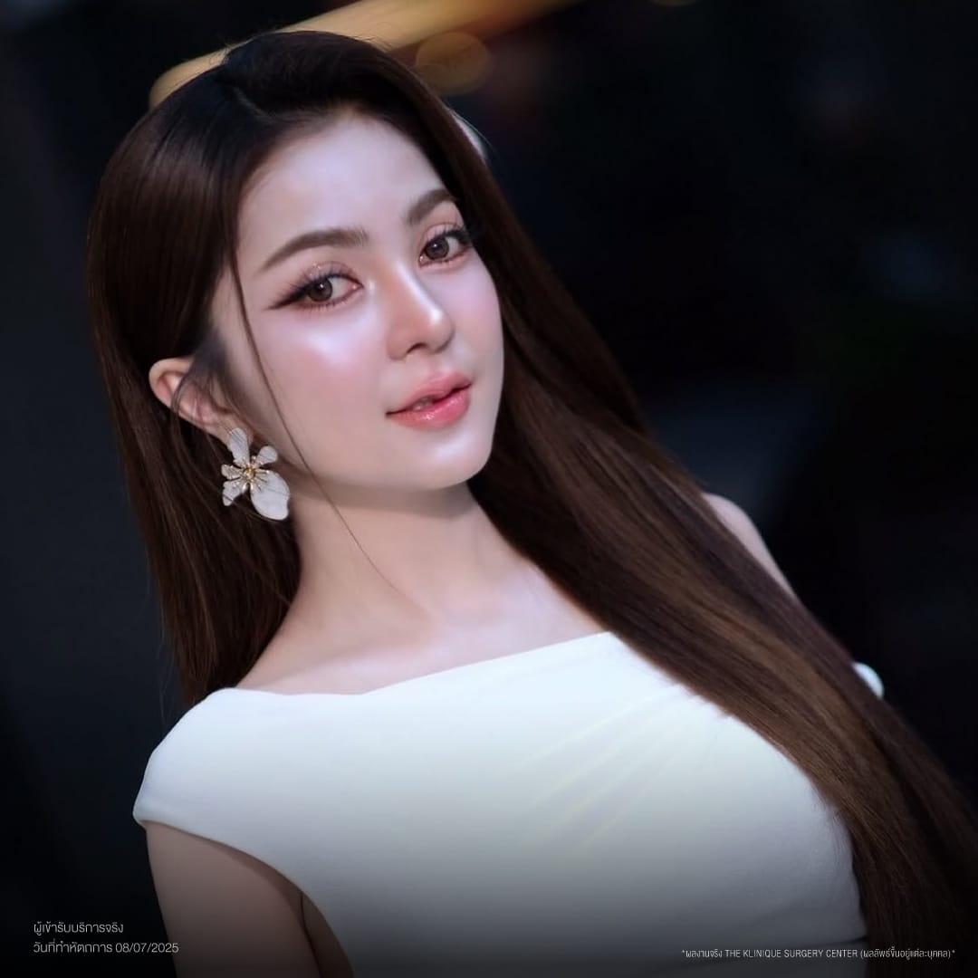 ศัลยกรรมจมูก, ศัลยกรรมจมูก รีวิว, เสริมจมูก, รีวิวเสริมจมูก, ทำจมูก, ทำจมูก รีวิว, ทำจมูก แบบ Open, ซิลิโคนจมูก, จมูก Open, เสริมจมูกโอเพ่น, เสริมจมูกOpen ที่ไหนดี, เสริมจมูกโอเพ่น ที่ไหนดี, เสริมจมูกโอเพ่น Open คือ, รีวิวเสริมจมูกโอเพ่น Open, ทรงจมูก, ทรงจมูกสวย, ทรงจมูกธรรมชาติ, ทรงจมูกสโลปปลายพุ่ง, ศัลยกรรมจมูกทีไ่หนดี, ศัลยกรรมจมูกมีกี่แบบ, เสริมจมูกที่ไหนดี, เสริมจมูกโอเพ่น, เสริมจมูกOpen, ทำจมูกรีวิว, ซิลิโคนจมูก,แก้จมูก, แก้จมูกที่ไหนดี, ทรงจมูกผู้ชาย, เสริมจมูกผู้ชาย, ศัลยฯจมูก, ถอดซิลิโคนจมูก, จมูก Semi Open