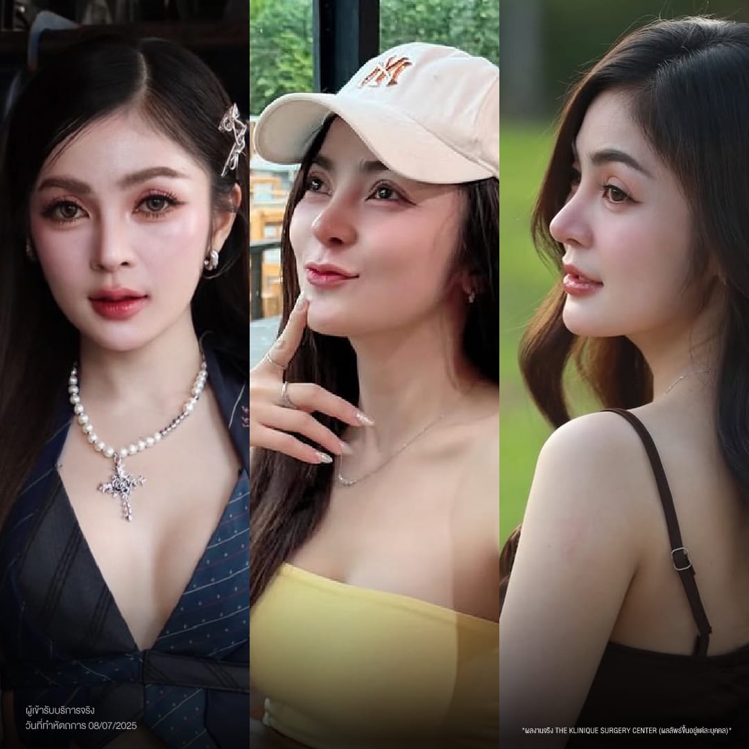 ศัลยกรรมจมูก, ศัลยกรรมจมูก รีวิว, เสริมจมูก, รีวิวเสริมจมูก, ทำจมูก, ทำจมูก รีวิว, ทำจมูก แบบ Open, ซิลิโคนจมูก, จมูก Open, เสริมจมูกโอเพ่น, เสริมจมูกOpen ที่ไหนดี, เสริมจมูกโอเพ่น ที่ไหนดี, เสริมจมูกโอเพ่น Open คือ, รีวิวเสริมจมูกโอเพ่น Open, ทรงจมูก, ทรงจมูกสวย, ทรงจมูกธรรมชาติ, ทรงจมูกสโลปปลายพุ่ง, ศัลยกรรมจมูกทีไ่หนดี, ศัลยกรรมจมูกมีกี่แบบ, เสริมจมูกที่ไหนดี, เสริมจมูกโอเพ่น, เสริมจมูกOpen, ทำจมูกรีวิว, ซิลิโคนจมูก,แก้จมูก, แก้จมูกที่ไหนดี, ทรงจมูกผู้ชาย, เสริมจมูกผู้ชาย, ศัลยฯจมูก, ถอดซิลิโคนจมูก, จมูก Semi Open