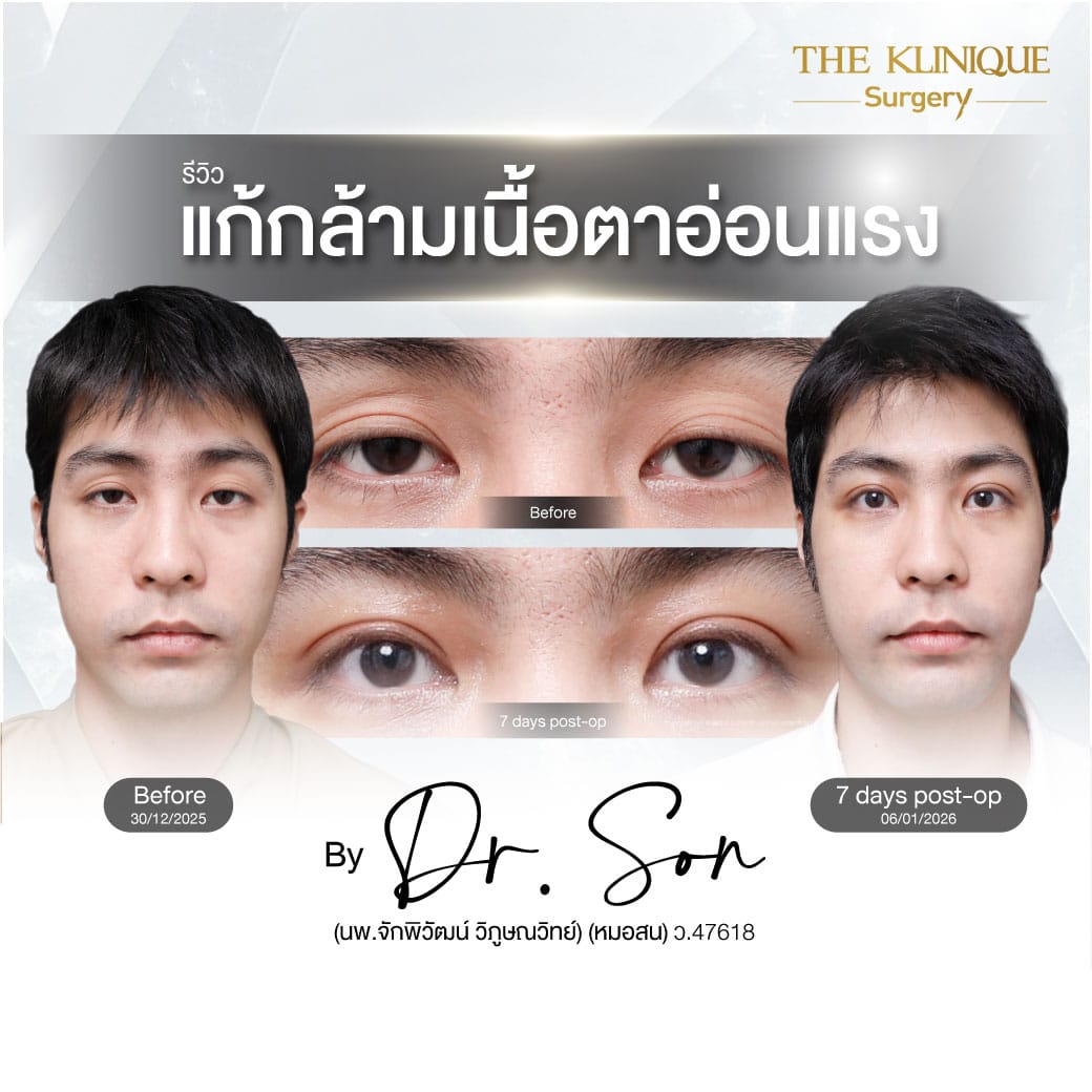 ศัลยกรรมตา, ศัลยกรรมตาสองชั้น, ศัลยกรรมตาสองชั้น ราคา, ศัลยกรรมตาที่ไหนดี, ศัลยกรรมตามีกี่แบบ, ตาสองชั้น, ตาสองชั้นหลบใน, คลินิกทำตา, ตาสองชั้นที่ไหนดี, ตาสองชั้นแบบกรีดสั้น กรีดยาว, กล้ามเนื้อตาอ่อนแรง, แก้ตา, แก้ตาสองชั้น, แก้หนังตาตก, แก้ชั้นตาใหญ่, แก้ตาไม่เท่ากัน, หนังตาตก, แก้หนังตาตก,Ophthalmologis,จักษุศัลยแพทย์,คลินิกทำตาสองชั้น ใจกลางสยามสแคว์ , แก้ตาอ่อนแรง ใจกลางสยาม,ตาง่วง, ตาปรือ, ทำตาสองชั้นที่ไหนดี, แพทย์ Oculoplastic, มัดกล้ามเนื้อตา, รีวิวแก้กล้ามเนื้อตาอ่อนแรง, แก้ไขกล้ามเนื้อตาอ่อนแรง