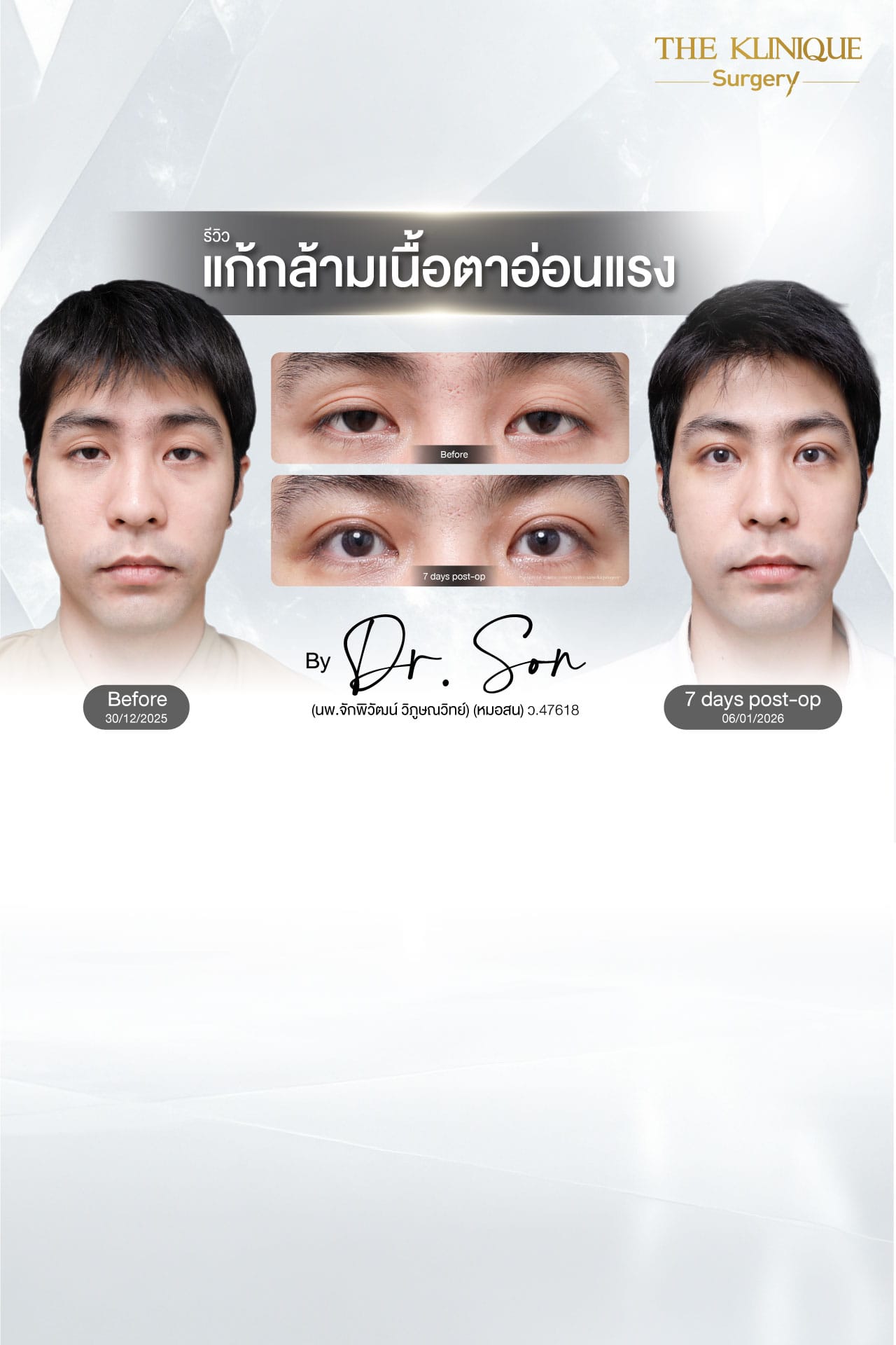 ศัลยกรรมตา, ศัลยกรรมตาสองชั้น, ศัลยกรรมตาสองชั้น ราคา, ศัลยกรรมตาที่ไหนดี, ศัลยกรรมตามีกี่แบบ, ตาสองชั้น, ตาสองชั้นหลบใน, คลินิกทำตา, ตาสองชั้นที่ไหนดี, ตาสองชั้นแบบกรีดสั้น กรีดยาว, กล้ามเนื้อตาอ่อนแรง, แก้ตา, แก้ตาสองชั้น, แก้หนังตาตก, แก้ชั้นตาใหญ่, แก้ตาไม่เท่ากัน, หนังตาตก, แก้หนังตาตก,Ophthalmologis,จักษุศัลยแพทย์,คลินิกทำตาสองชั้น ใจกลางสยามสแคว์ , แก้ตาอ่อนแรง ใจกลางสยาม,ตาง่วง, ตาปรือ, ทำตาสองชั้นที่ไหนดี, แพทย์ Oculoplastic, มัดกล้ามเนื้อตา, รีวิวแก้กล้ามเนื้อตาอ่อนแรง, แก้ไขกล้ามเนื้อตาอ่อนแรง