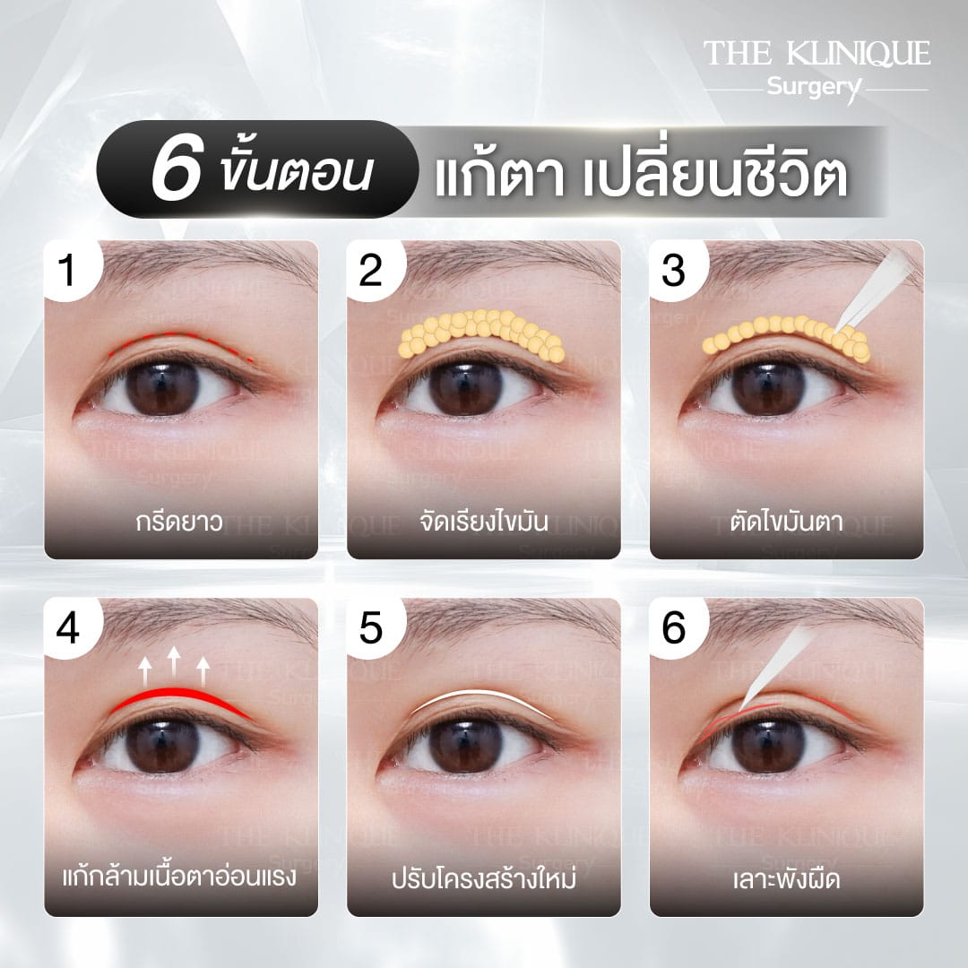 "Before and after revision double eyelid surgery by Dr. Son at THE KLINIQUE
