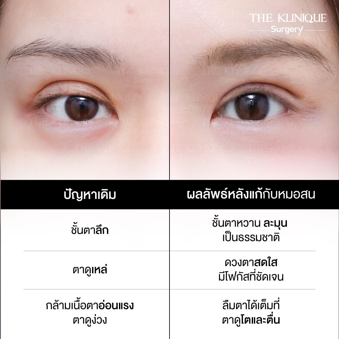 "Before and after revision double eyelid surgery by Dr. Son at THE KLINIQUE