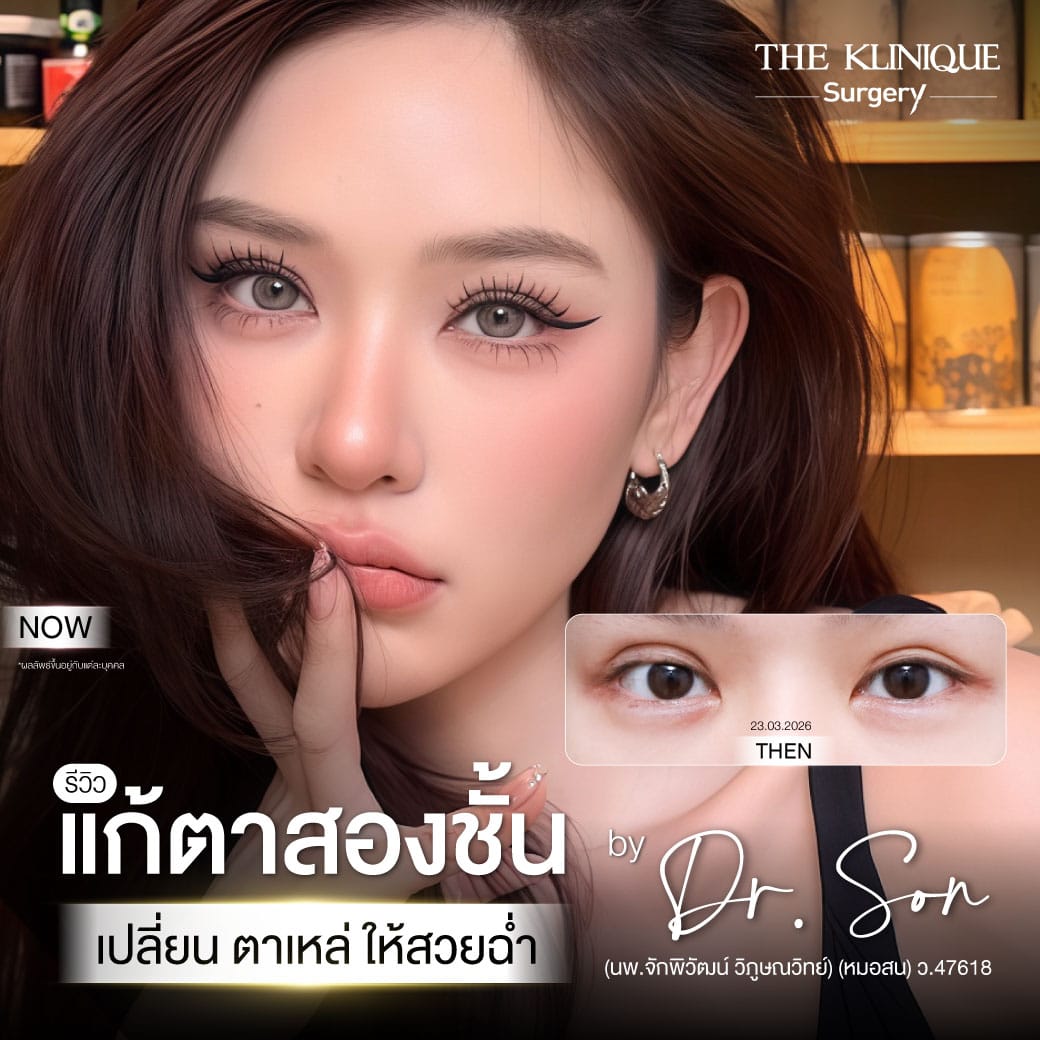 "Before and after revision double eyelid surgery by Dr. Son at THE KLINIQUE
