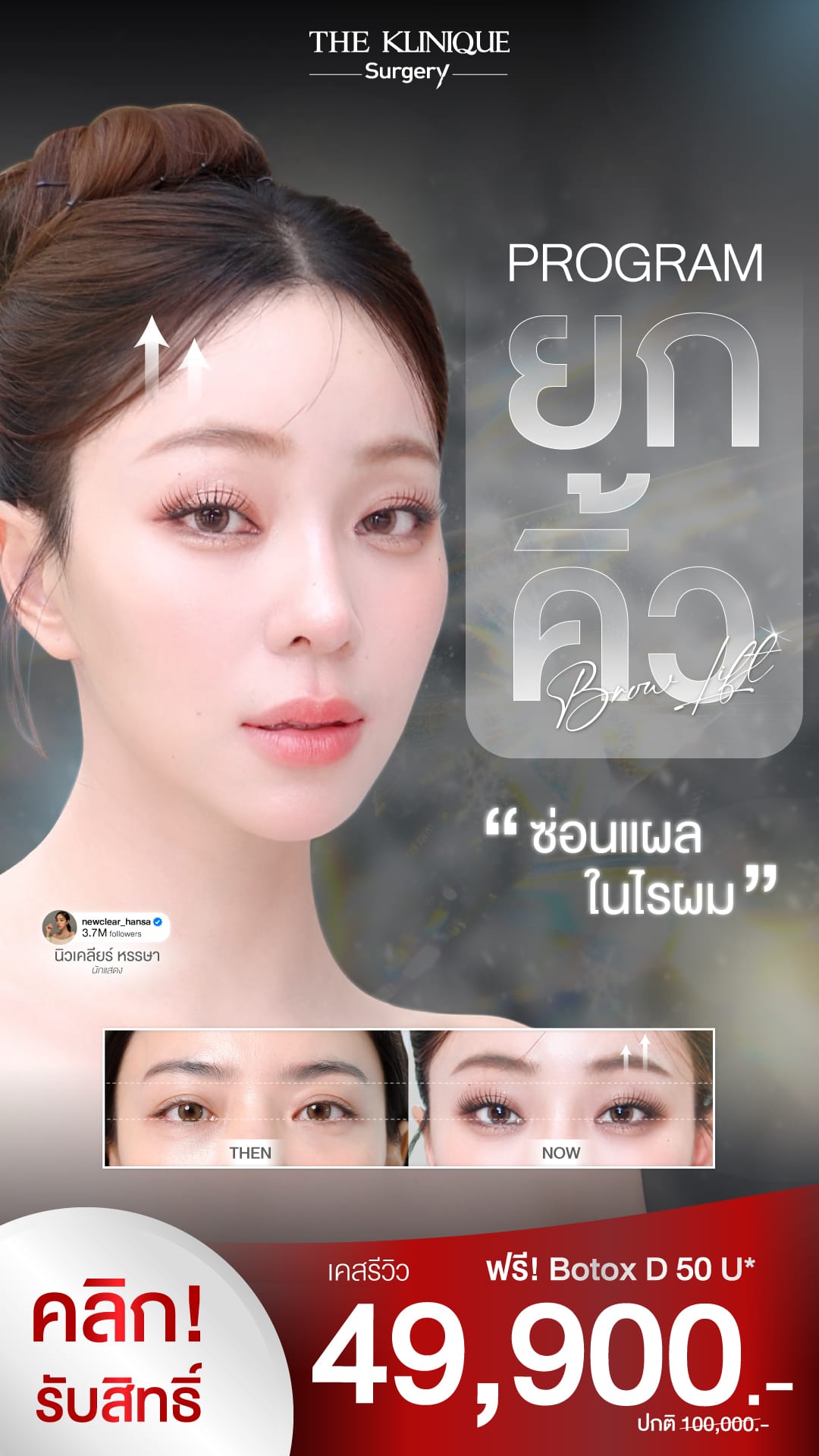 Endotine” style=